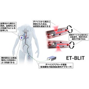 体を隅々まで照らす新規生体光デバイス・システムを開発 血管内治療技術を応用した光照射デバイス・システム(ET-BILT)開発に成功～さまざまな光治療技術の臨床応用に道を切り開く～