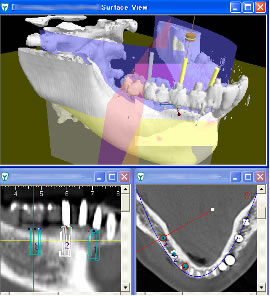 図２　シミュレーション画面 （左）人工歯根埋入位置の確認