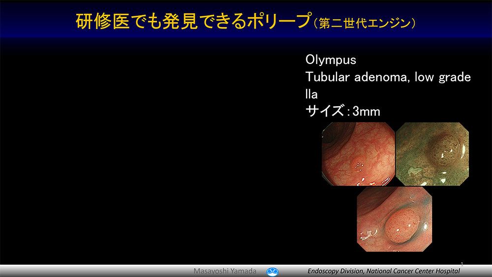 研修医でも発見できるッポリープ(第二世代エンジン)