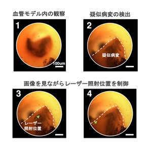 観察とレーザー治療を同時に実現！ 細径イメージガイドレーザー焼灼技術を開発