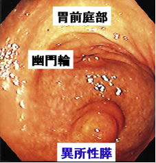 図１:ヒトの胃前庭部大弯にみとめられる異所性膵