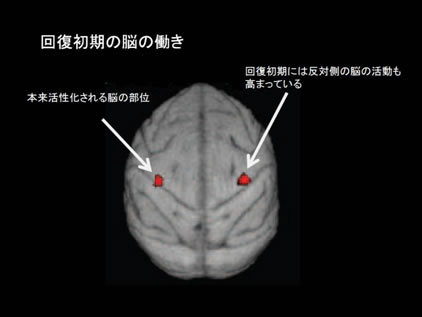 図２　回復初期（１ヵ月）に活動が増加する脳の部位（PET画像）