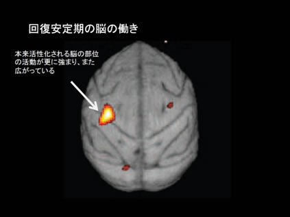 図３　回復安定期（３ヵ月）に活動が増加する脳の部位（PET画像）