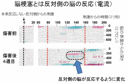 脳梗塞でも反対側の脳が失われた機能を 肩代わり 神経回路のつなぎ換えと機能回復を順々に促進