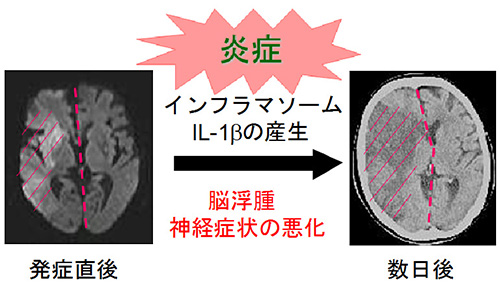 共同発表 脳梗塞後の炎症が悪化するメカニズムを解明 白血病治療薬が脳梗塞の治療にも使える可能性