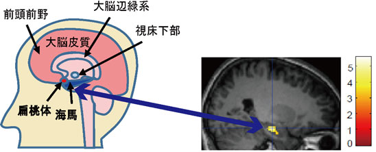 経済的な不平等とうつ病傾向を結ぶ扁桃体と海馬の機能を解明