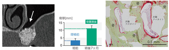 共同発表：世界初、骨の無機成分と同組成の人工骨の開発・実用化
