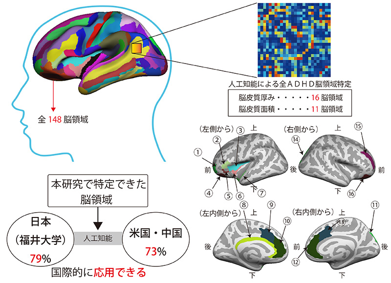 共同発表 ａｄｈｄの脳構造の特徴を人工知能により解明し 遺伝子多型の影響を発見