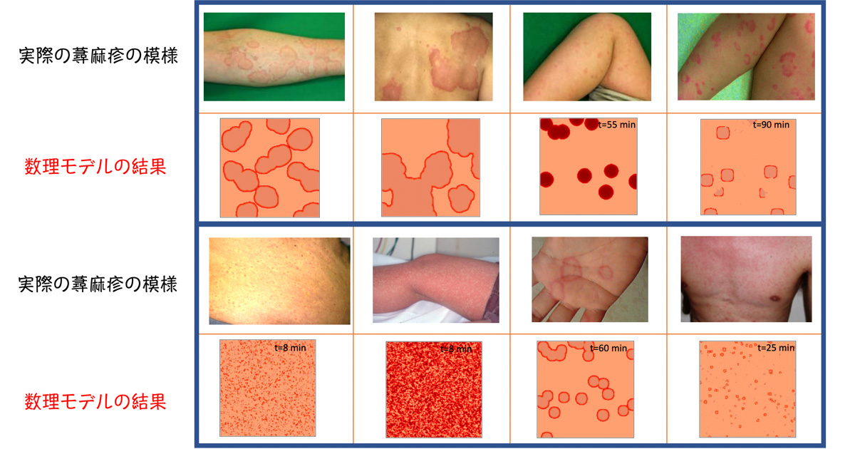 共同発表 蕁麻疹でみられる発疹の症状を数理モデルで再現 新たな治療法確立の可能性