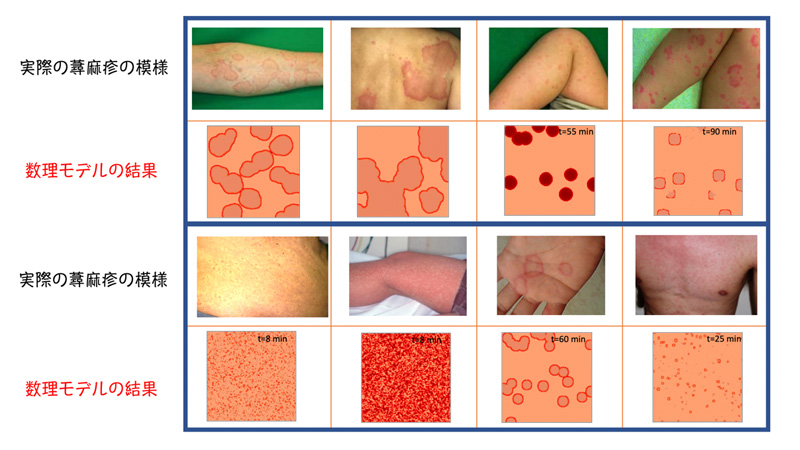 図２　蕁麻疹でみられる多様な幾何学的形態と数理モデルにより再現された膨疹の形態