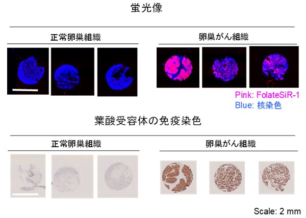 図6　凍結卵巣がん組織のマイクロアレイへの応用