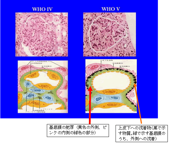 図１　増殖性腎炎(DPGN)（左側）と膜性腎炎(MGN)（右側）