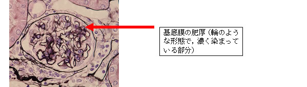 図２　IL-27受容体を欠損したMRL/lprマウスにおける糸球体毛細血管基底膜の特徴的肥厚（上図、赤矢印）