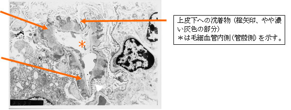 上皮下への沈着物（下図、橙矢印）