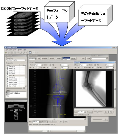 人工関節術前計画システム（TXA Simula Ver.1.0）