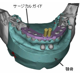 図２　シミュレーション画面 （右）サージカルガイドの設計