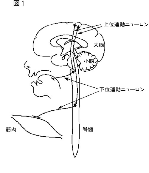 若年発症型筋萎縮性側索硬化症２型の原因遺伝子の単離 同定に成功