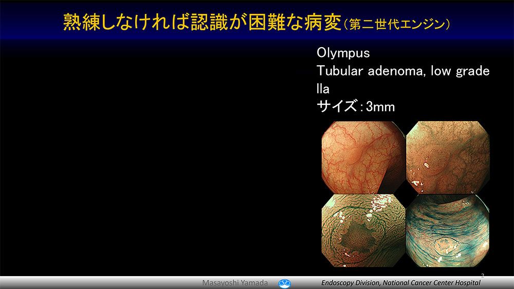 熟練しなければ認識が困難な病変(第二世代エンジン)