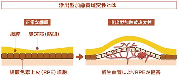 滲出型加齢黄斑変性とは