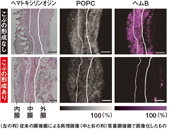 (左の列)従来の顕微鏡による病理画像(中と右の列)質量顕微鏡で画像化したもの
